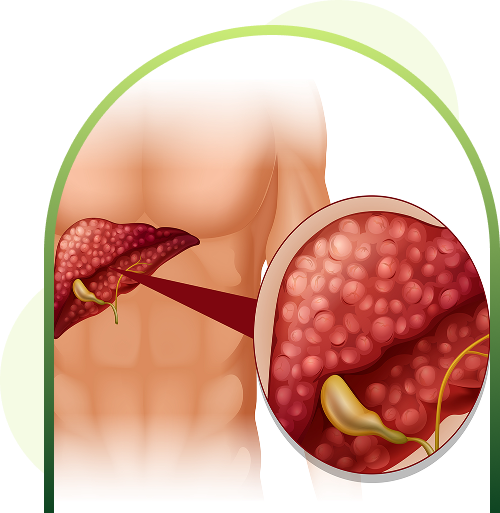 kidney disease