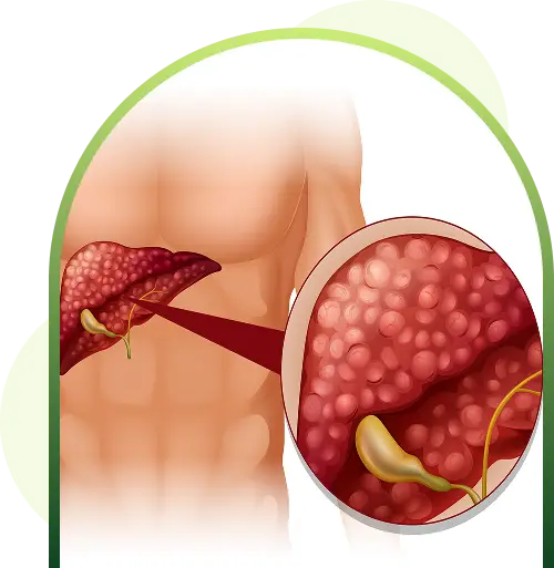 kidney disease