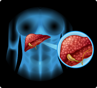 Fibrosis